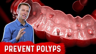 What is a Polyp  The Best Food for Colon Polyp Prevention  Dr. Berg