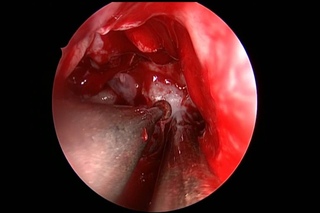 Endoscopic pituitary surgery