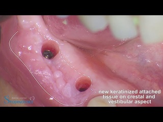 Apically repositioned flap (keratinized attached tissue procedure)
