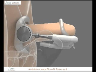 How To Use Jes-Extenders for Recover from Prostate Cancer and Pelvic Surgery